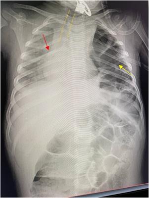 Case Report: Surgical challenges and insights in a child with a blunt left diaphragmatic and pericardial rupture and heart subluxation